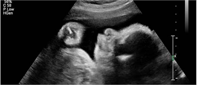 32 week ultrasound pics